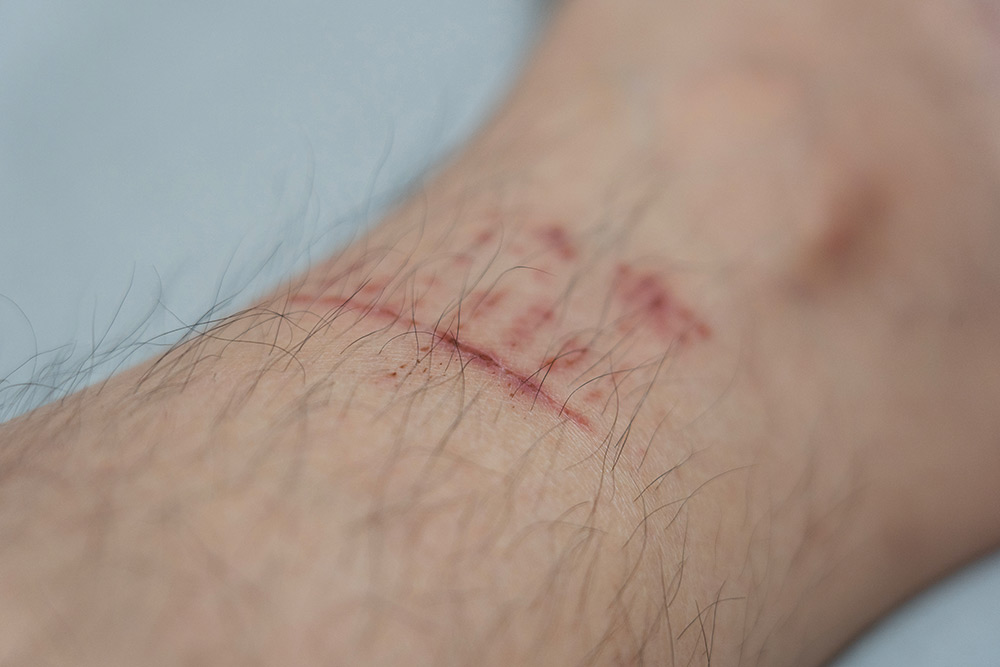 Burns scarring and laceration